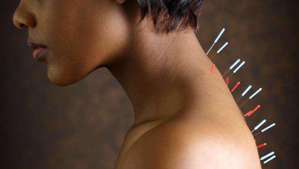 Akupunktur mit zervikaler Osteochondose