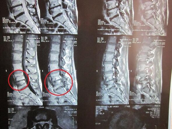 Diagnose einer zervikalen Osteochondose