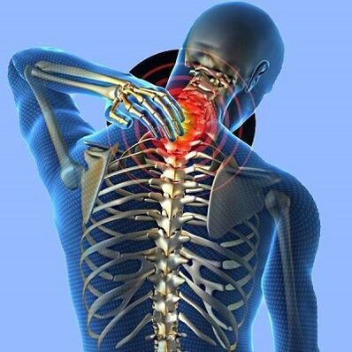 Nackenschmerzen mit zervikaler Osteochondose