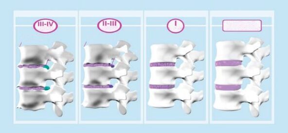 Phase der zervikalen Osteochondose