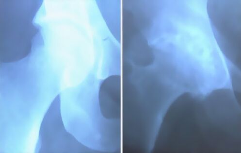 Hass der Arthrose des Kniegelenks