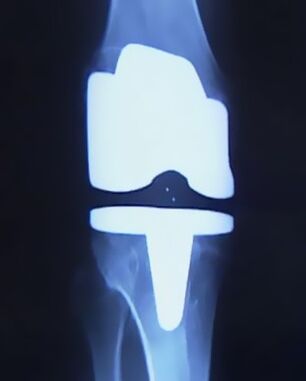 X -Reggi -Bild des Knies mit einer künstlichen Prothese nach der Operation, um das Gelenk zu verändern