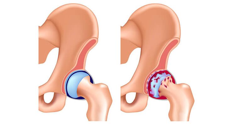 gesundes Hüftgelenk und von Arthrose betroffen