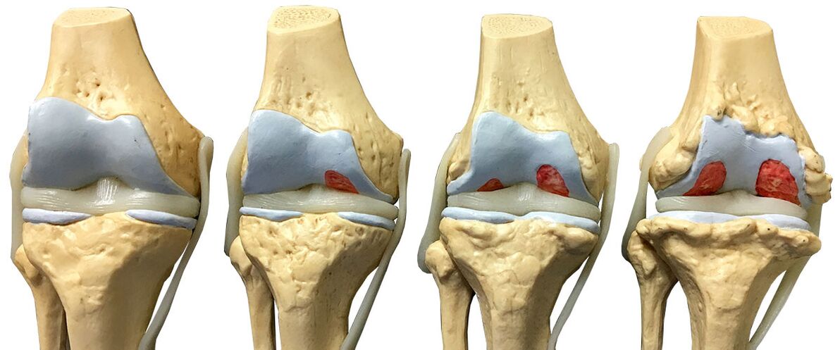 Osteoarthritis -Phase