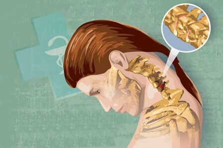 Reflexsymptome von Osteochondose